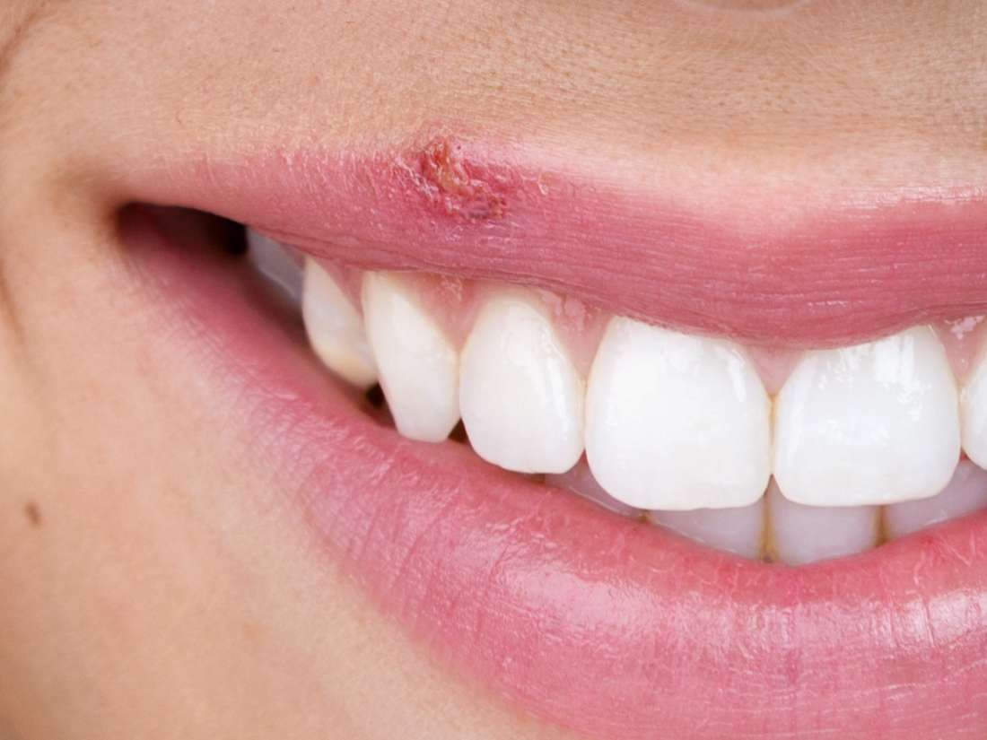 Easy Ways To Get Rid Of Cold Sores At Its Earliest
